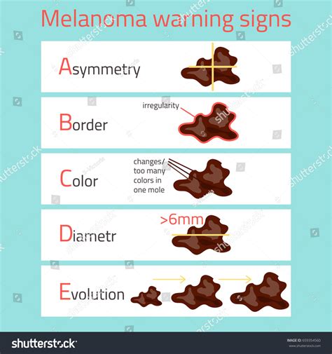 Melanoma Warning Signs Abcde Infographic Disease Stock Vector (Royalty ...