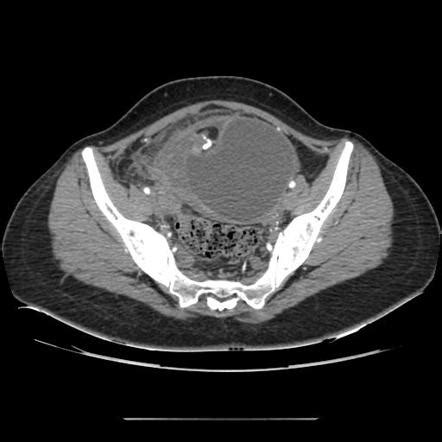 Mature Cystic Teratoma Image Radiopaedia Org