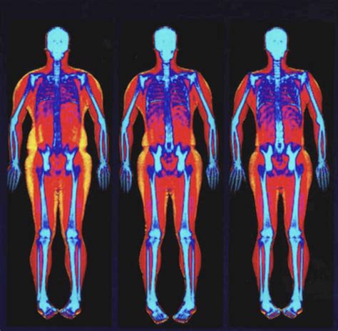 densitometria de corpo inteiro composicao corporal