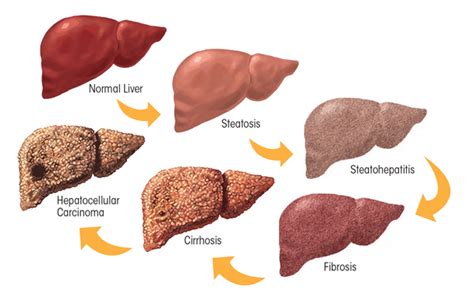 Alcoholic Liver Disease Pathogenesis And Current Management Alcohol