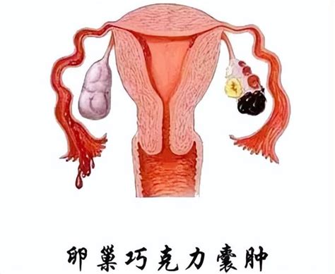 婦女節的關愛——聊聊卵巢囊腫 每日頭條