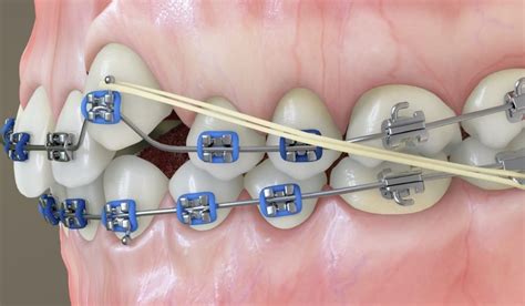 Como o aparelho ortodôntico faz a movimentação dentária Dentista