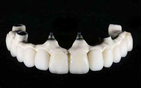 Bridges And Partial Dentures - Devonshire Dental Care