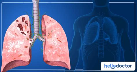 tuberculosis      prevented