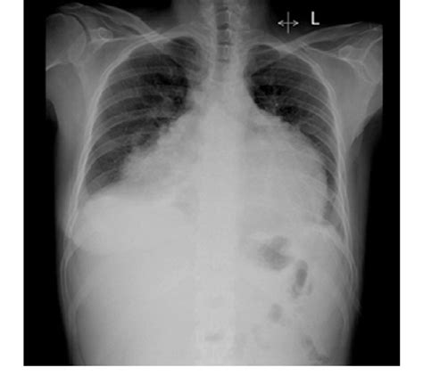 Patient 2 Posterior Anterior Cxr Displaying Cardiomegaly Indicative Of