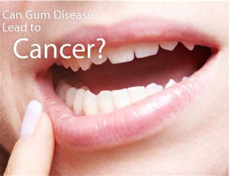 Gum Cancer Symptoms Pictures - Let's Talk about Oral Cancer - Moreover ...