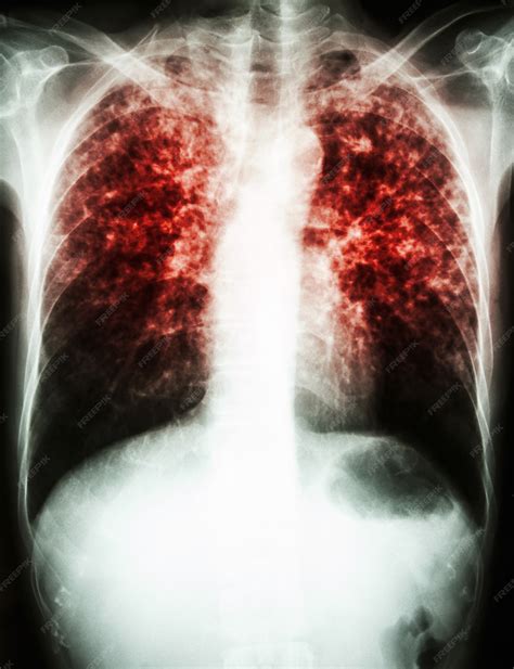 Mycobacterium Tuberculosis Lungs