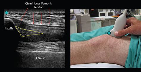 Knee Effusion Ultrasound