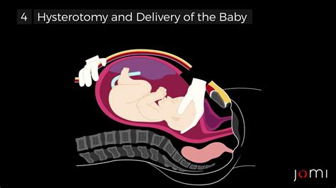 Primary Low Transverse C-Section Steps - YouTube