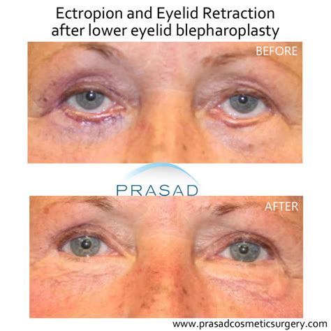 Ectropion After Lower Blepharoplasty