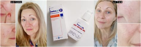 Rosacea Reviews: Metrogel 1% by Galderma - Confessions of a Refashionista