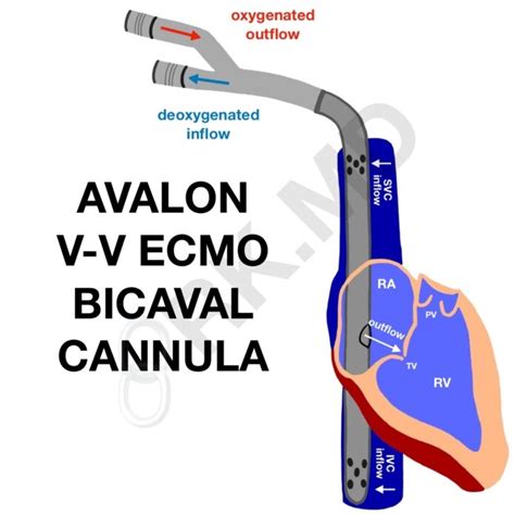 Avalon V V Ecmo Bicaval Catheter Rk Md