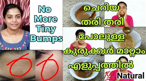 How To Remove Tiny Bumps From Face At Home 😍 7 Days Challenge Myself