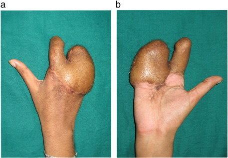 A And B Outcome Of The Right Hand Two Months After Thinning Of The Flap