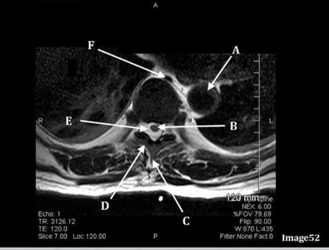 AXIAL T SPINE Diagram Quizlet