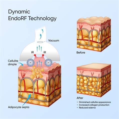 Zemits Bionexis Lite Pro Advanced Body Contouring System