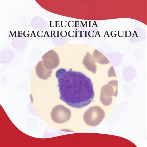 Leucemia Megacarioc Tica Aguda Atlas Em Hematologia