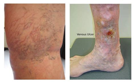 Varicose Veins Dr Shashikant S Jadhav