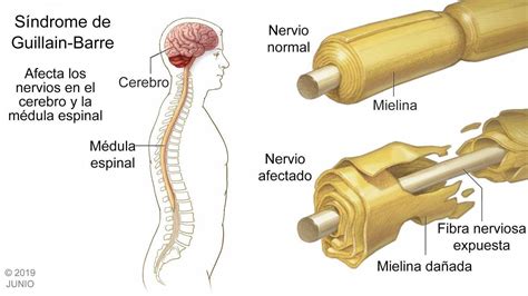 Síndrome De Guillain Barré Mapa Mental