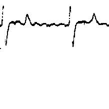 ECG recording from Apex-Base Lead by means of a conventional ECG ...