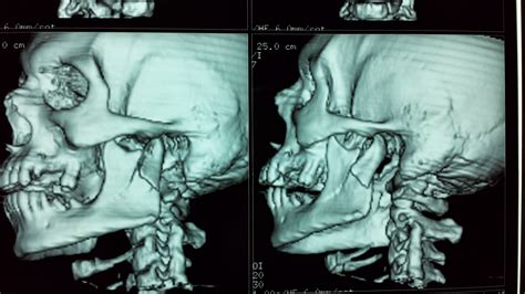 radiology ENT, Maxillofacial, Head and neck, neurosurgery, Dentology: subcondylar fracture of ...