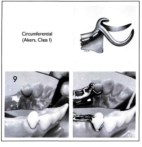 Partial Denture Clasp Types