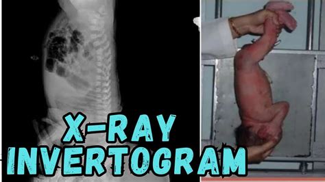 Invertogram X Ray Ll Invertogram Procedure Ll Invertogram X Ray