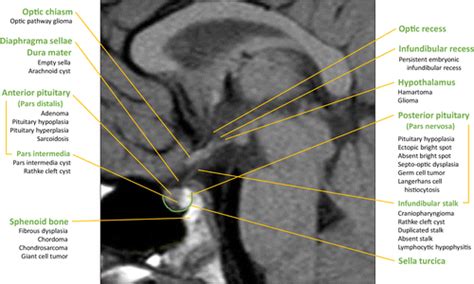 Systematic Approach To Evaluating Sellar And Suprasellar Lesions In