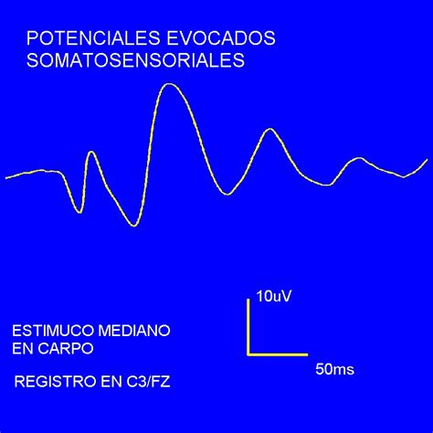 Potenciales Evocados Somatosensoriales