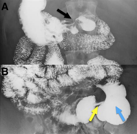 A Mild Deformity In The Duodenal Bulb Black Arrow B Stenosis In Download Scientific