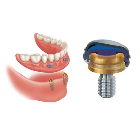 SX100801 LOCATOR Pacific Dental Specialties New Zealand