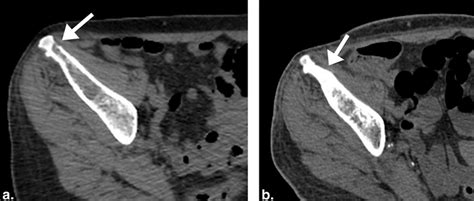 A Lytic Bone Metastasis Of The Right Iliac Bone Arrow Is Well Download Scientific Diagram