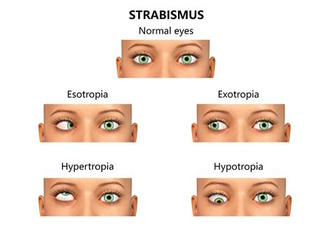 Strabismus surgery - Southside Eye Centre