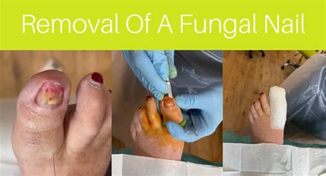 Toenail Fungus Before And After