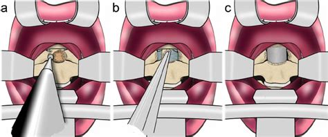 Illustrations Depicting The Transoral Trans Atlas Technique A This Download Scientific