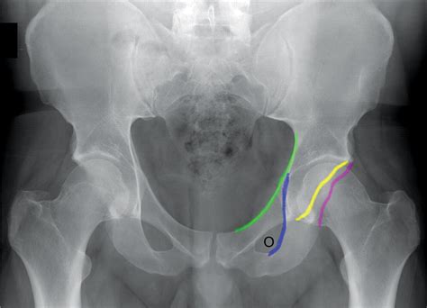 Classification Of Common Acetabular Fractures Radiographic And CT