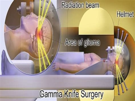 Gamma Beam Therapy The Best Picture Of Beam