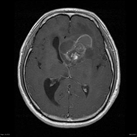 Ependymoma MRI - wikidoc