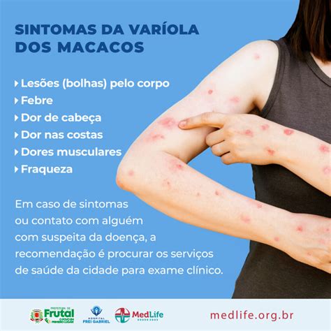 Quais são os sintomas da varíola dos macacos? - Med Life