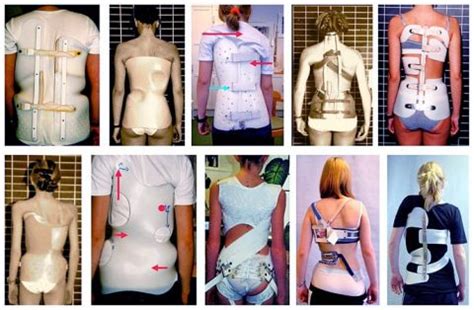 Scoliosis Brace Types, Effectiveness & Disadvantages