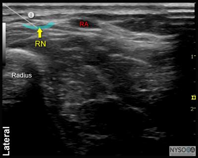 Radial Nerve Block Ultrasound