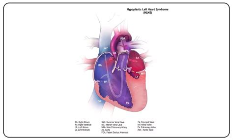 Study finds new genes that may contribute to congenital heart diseases