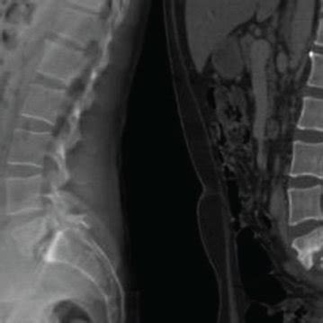 Preoperative A Lumbar Spine Radiography In Standing Position And B