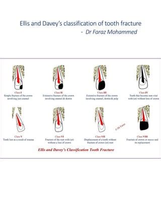 Ellis and davey’s classification of tooth fracture | PDF