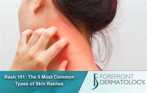 Rash 101 The 5 Most Common Types Of Skin Rashes DermSpecialists