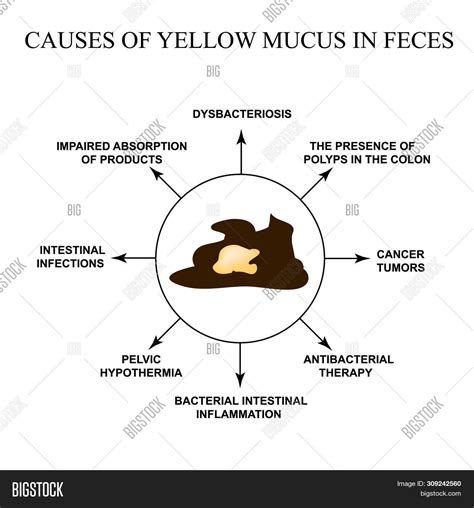 Causes Yellow Mucus Image & Photo (Free Trial) | Bigstock