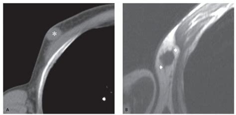 Superficial Soft Tissues Masses Radiology Key