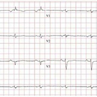 Case 2: Electrocardiogram with notable low limb voltage, fulfilling the ...