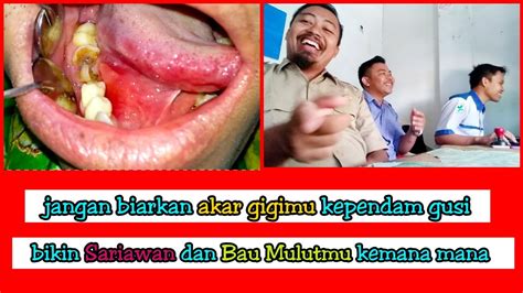 Pencabutan Sisa Akar Gigi Geraham Yang Bikin Sariawan Youtube