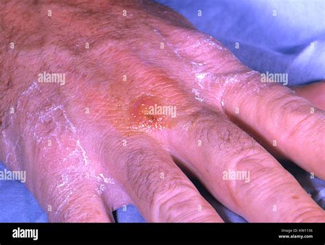 A Tularemia Lesion On The Dorsal Skin Of The Right Hand Caused By The